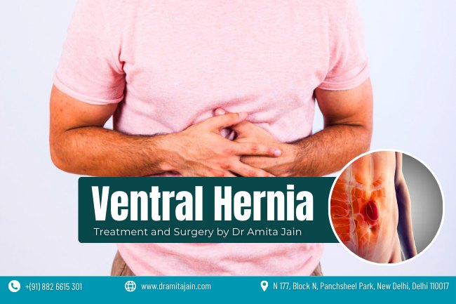 ventral Hernia doctor and Surgeon Dr Amita Jain Dr Amita Jain best surgeon for ventral hernia in Delhi and India